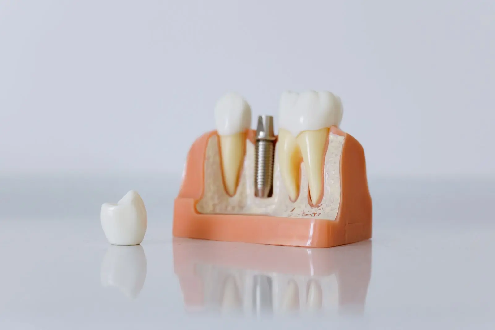 Modelo odontológico demonstrando a substituição de um dente por implante