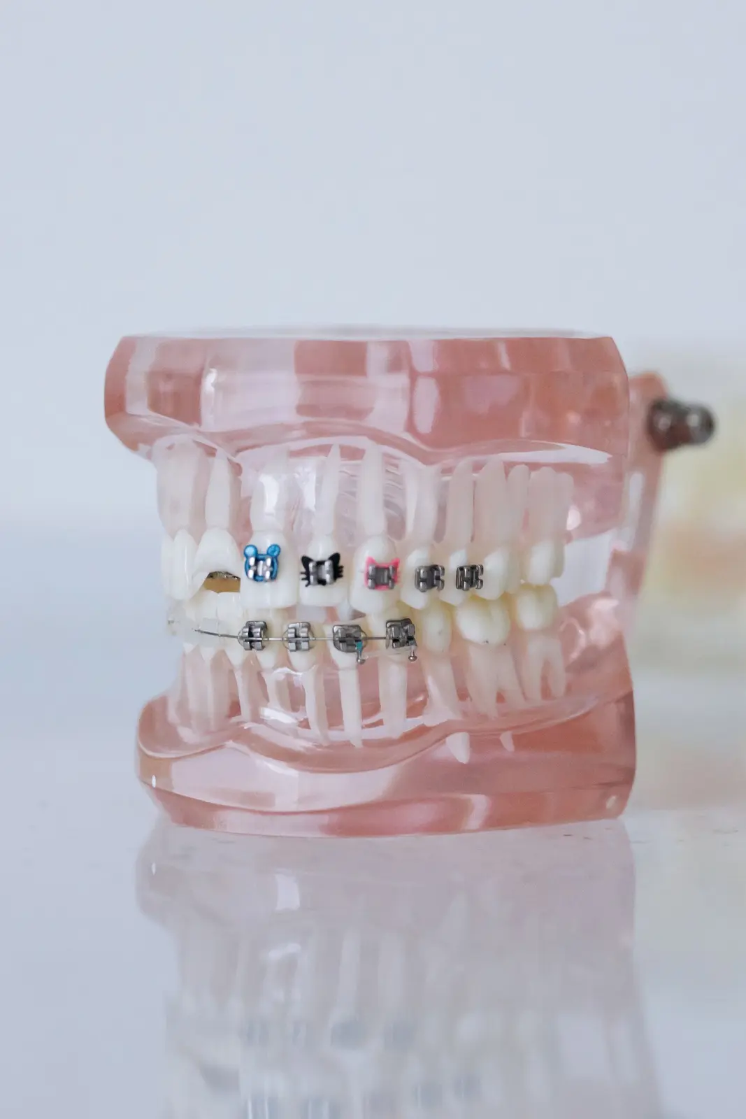 Modelo odontológico com diferentes tipos de aparelhos ortodônticos